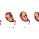 which placenta position is best for normal delivery