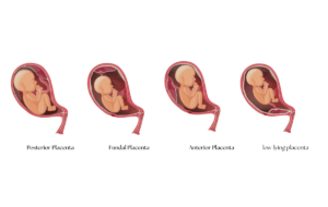 which placenta position is best for normal delivery